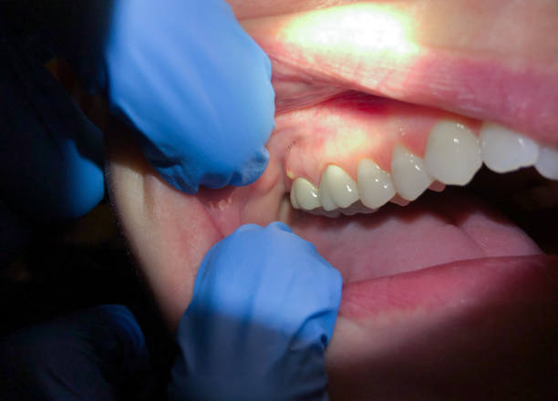 Best Emergency Dental Services for Seniors in Century, FL